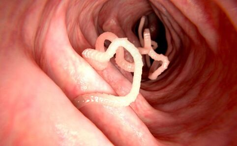 Σκουλήκια στο ανθρώπινο σώμα