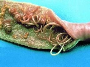 Οι αιτίες των παρασίτων στο ανθρώπινο σώμα