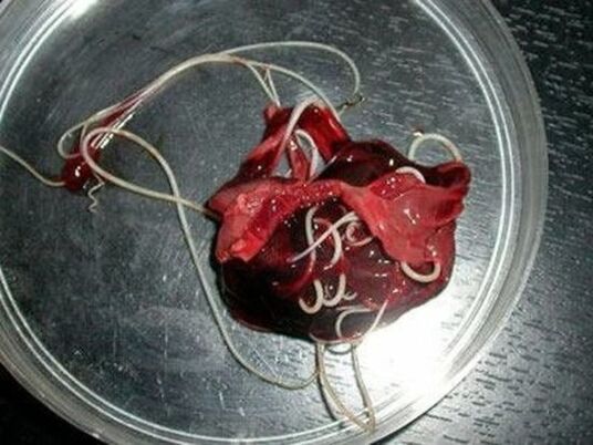 Σκουλήκια από το ανθρώπινο σώμα